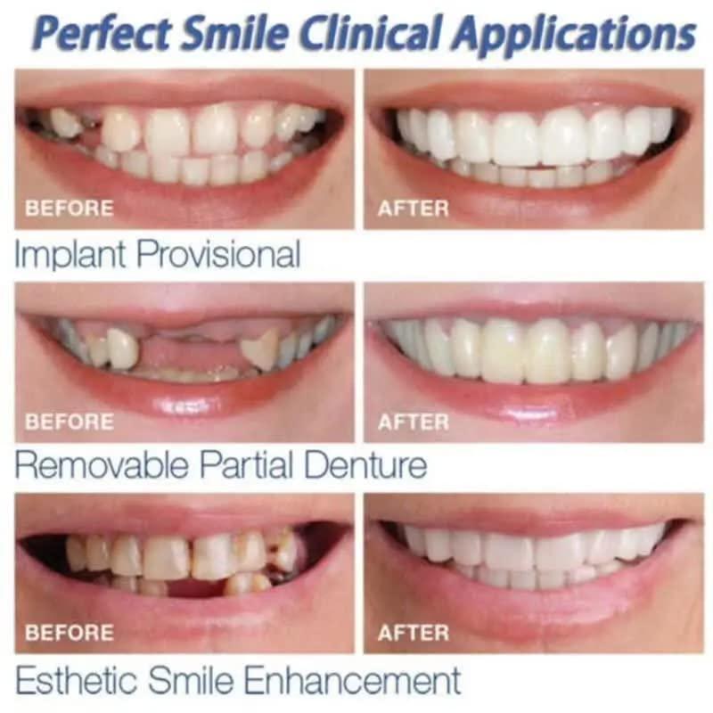 Snap Teeth Covers – Natural Look, Instant Smile Upgrade