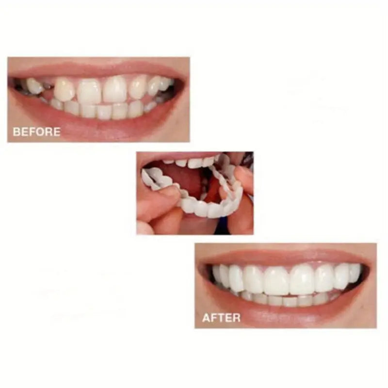 Snap Teeth Covers – Natural Look, Instant Smile Upgrade