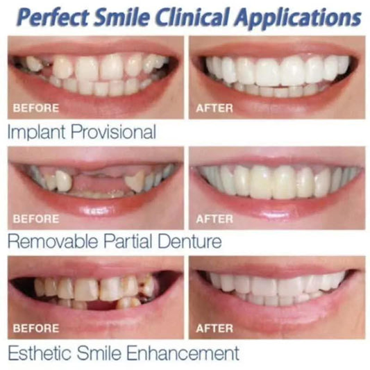 Snap Teeth Covers – Natural Look, Instant Smile Upgrade